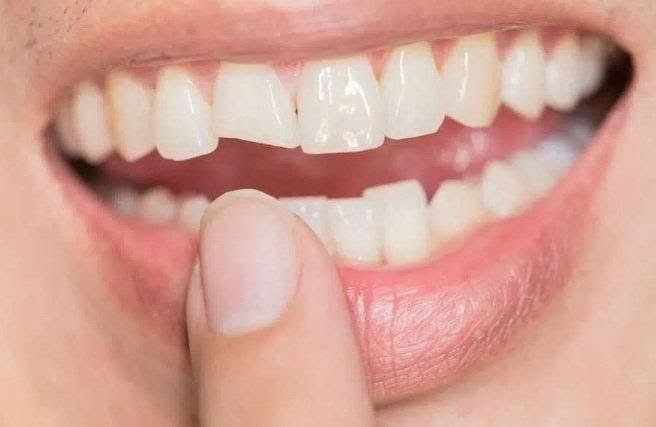 Home Remedy for Broken Tooth with Exposed Nerve: 2026 Expert Guide to Emergency Relief